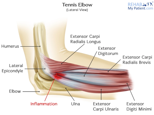 Elbow Tendinitis and Tennis Elbow Treatment?